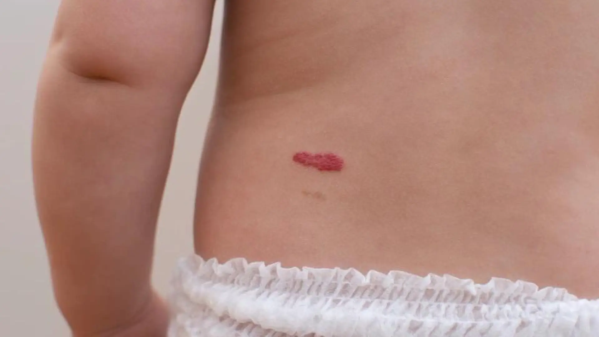 marcas de nacimiento marrones