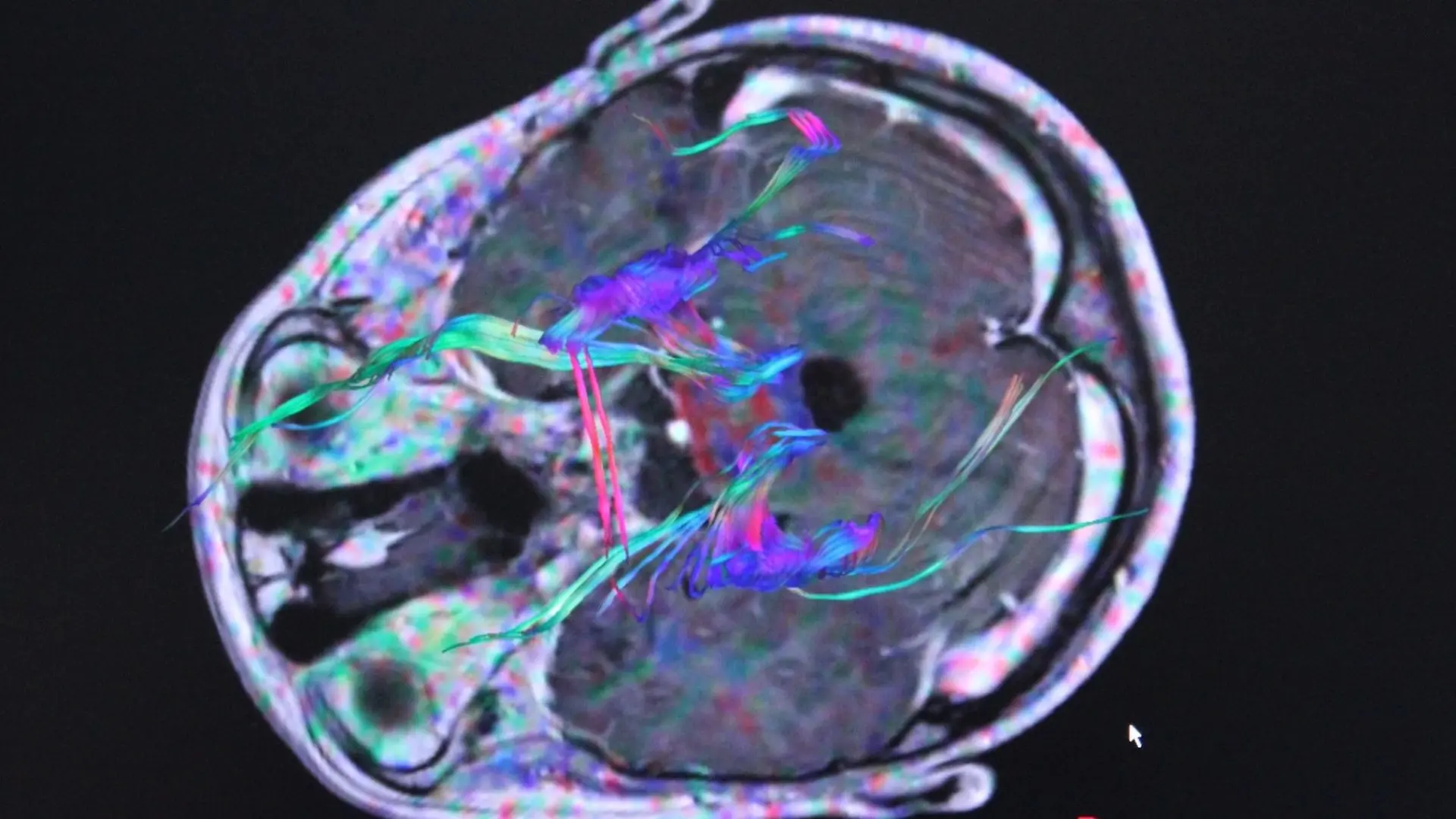 El deterioro de la memoria puede comenzar en el aparato digestivo