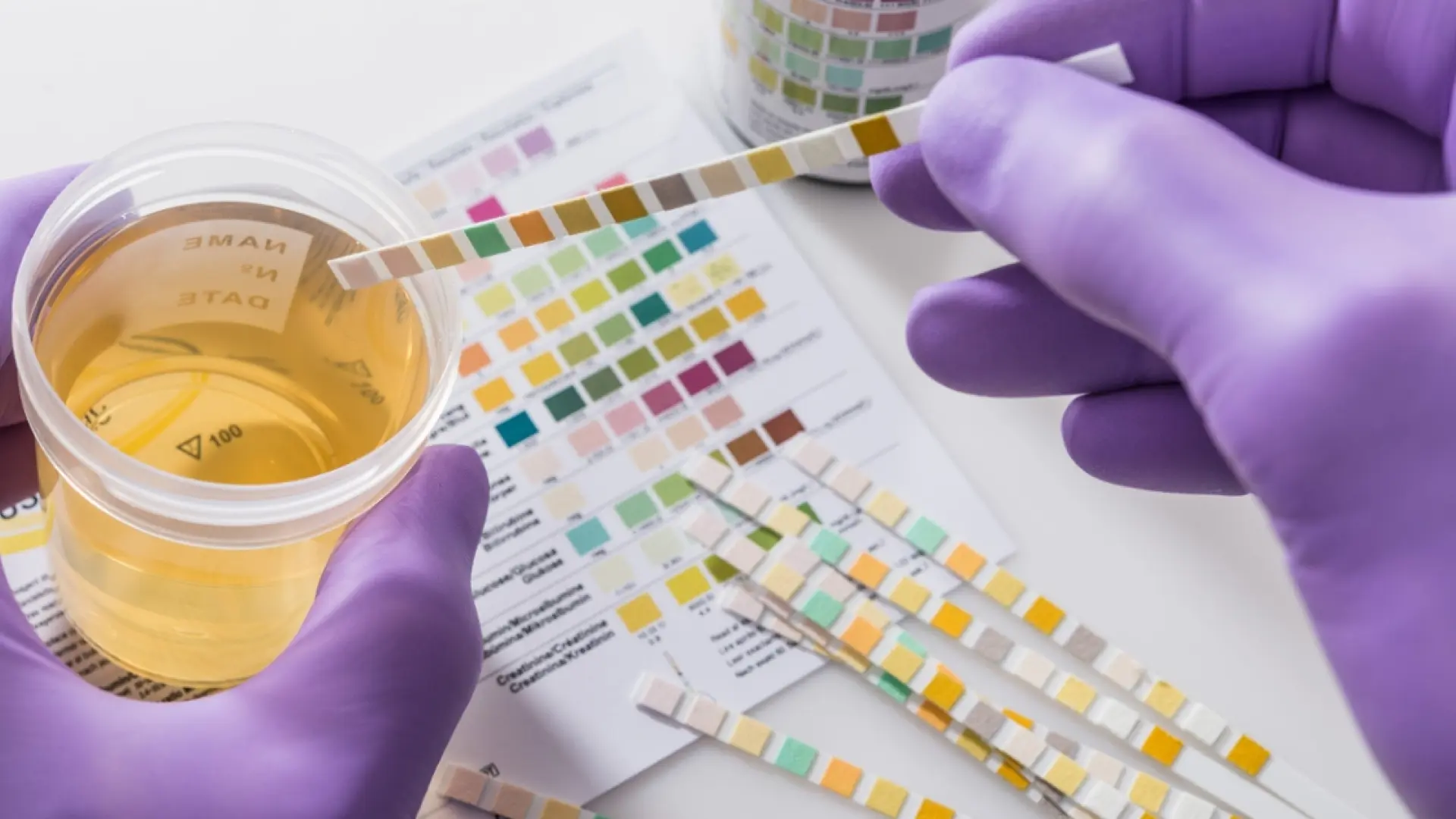 Orina con espuma ¿Cuándo deberíamos preocuparnos?