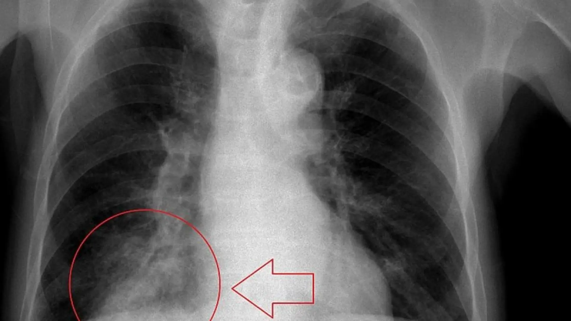 La contaminación acelera el enfisema pulmonar tanto como una caja de