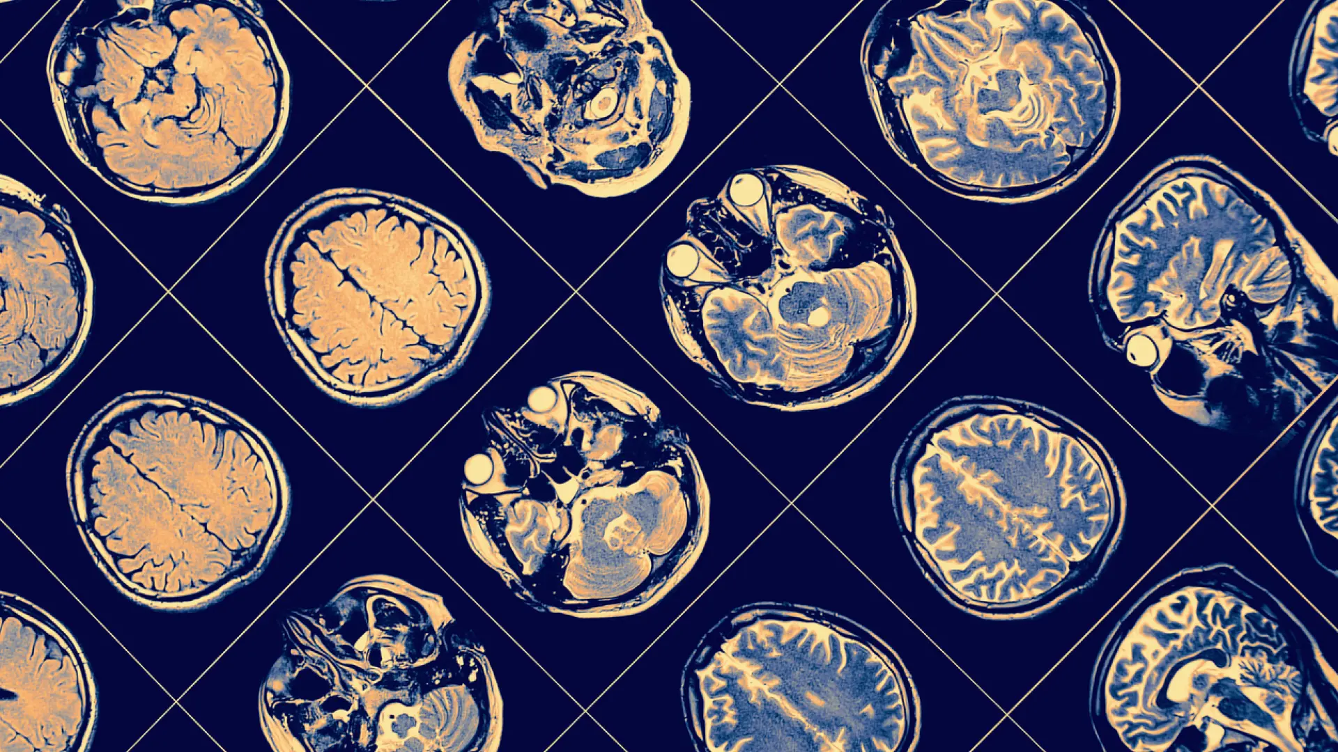 Descubren un compuesto que podría reducir el daño cerebral tras un traumatismo craneoencefálico