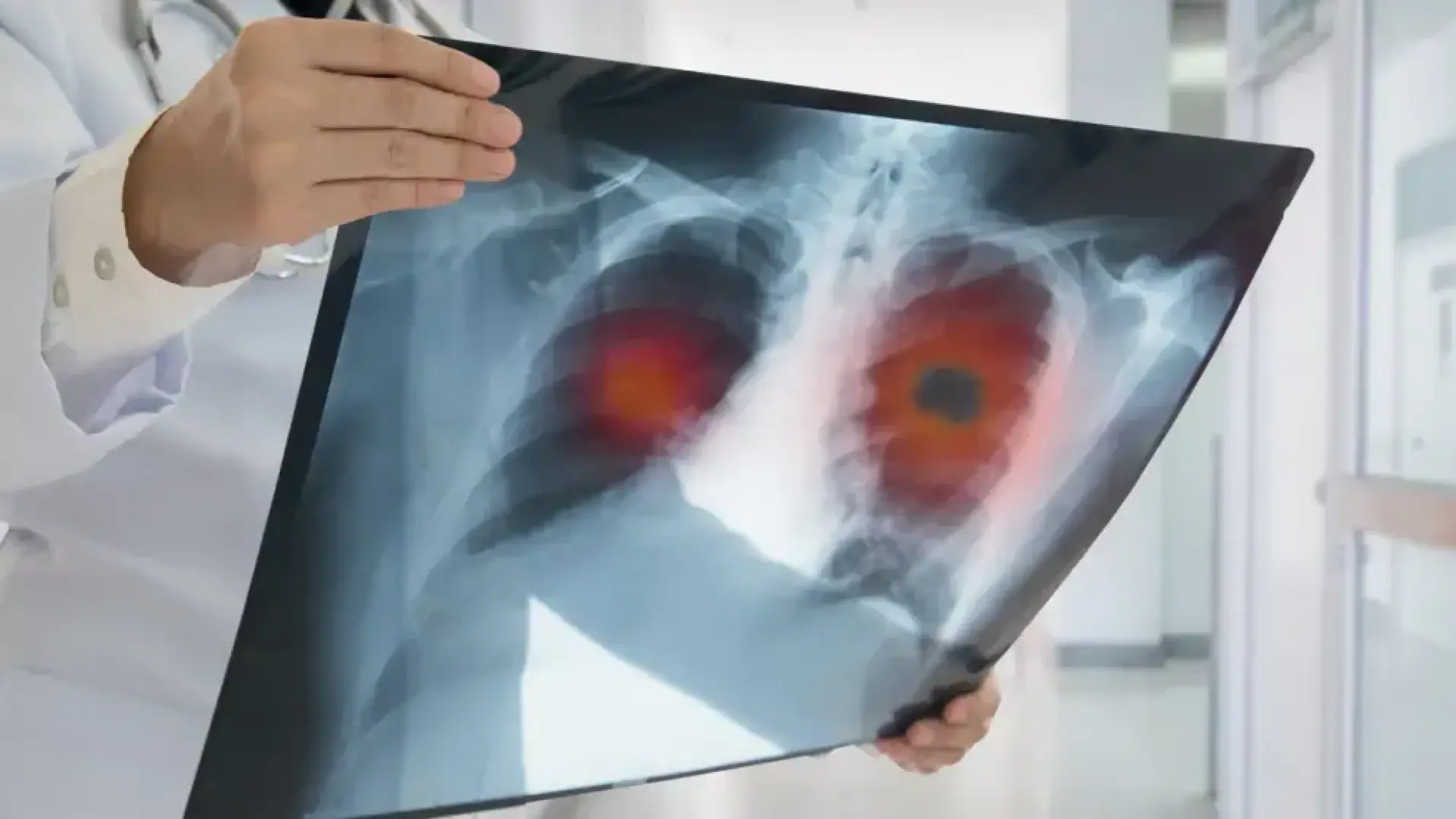 Hallada una nueva vía para potenciar la inmunoterapia en el cáncer de pulmón más agresivo thumbnail
