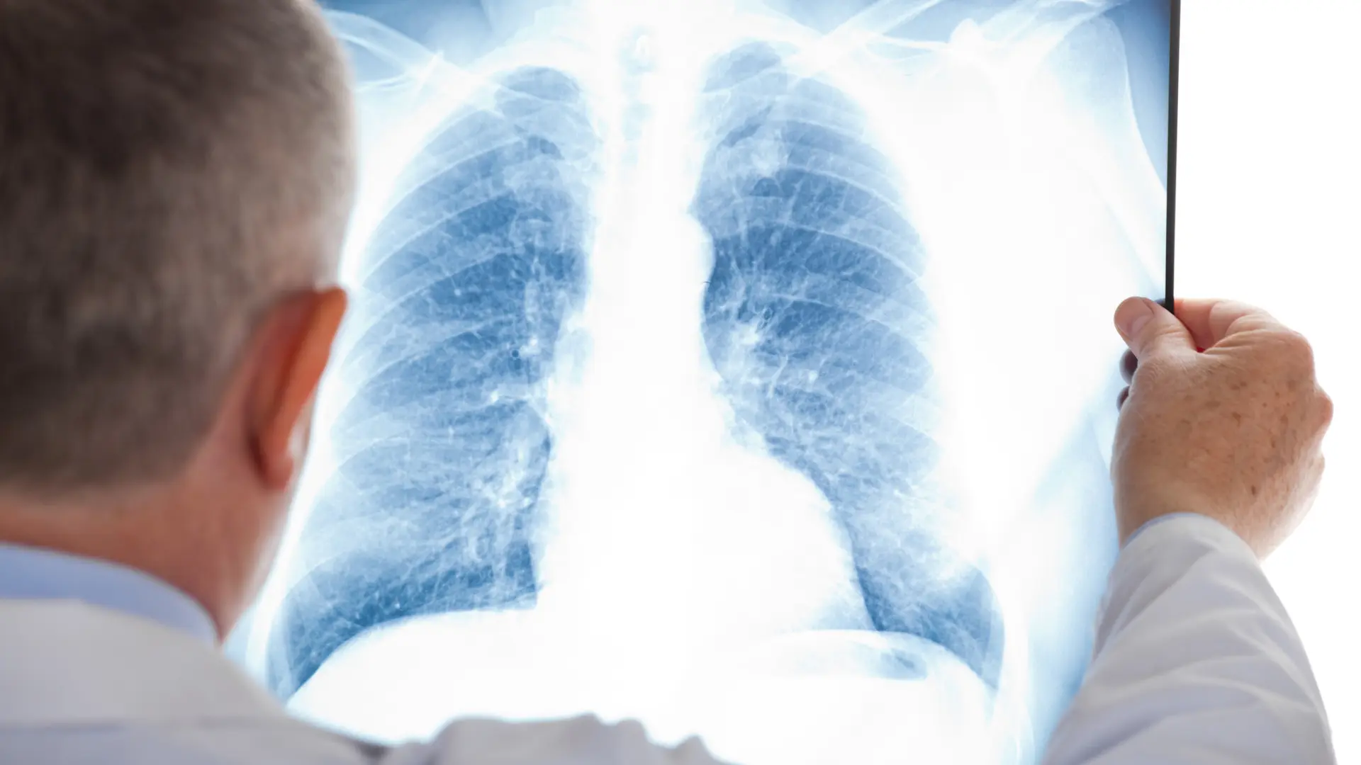 Desarrollan un método para detectar el hígado graso con radiografías de tórax thumbnail