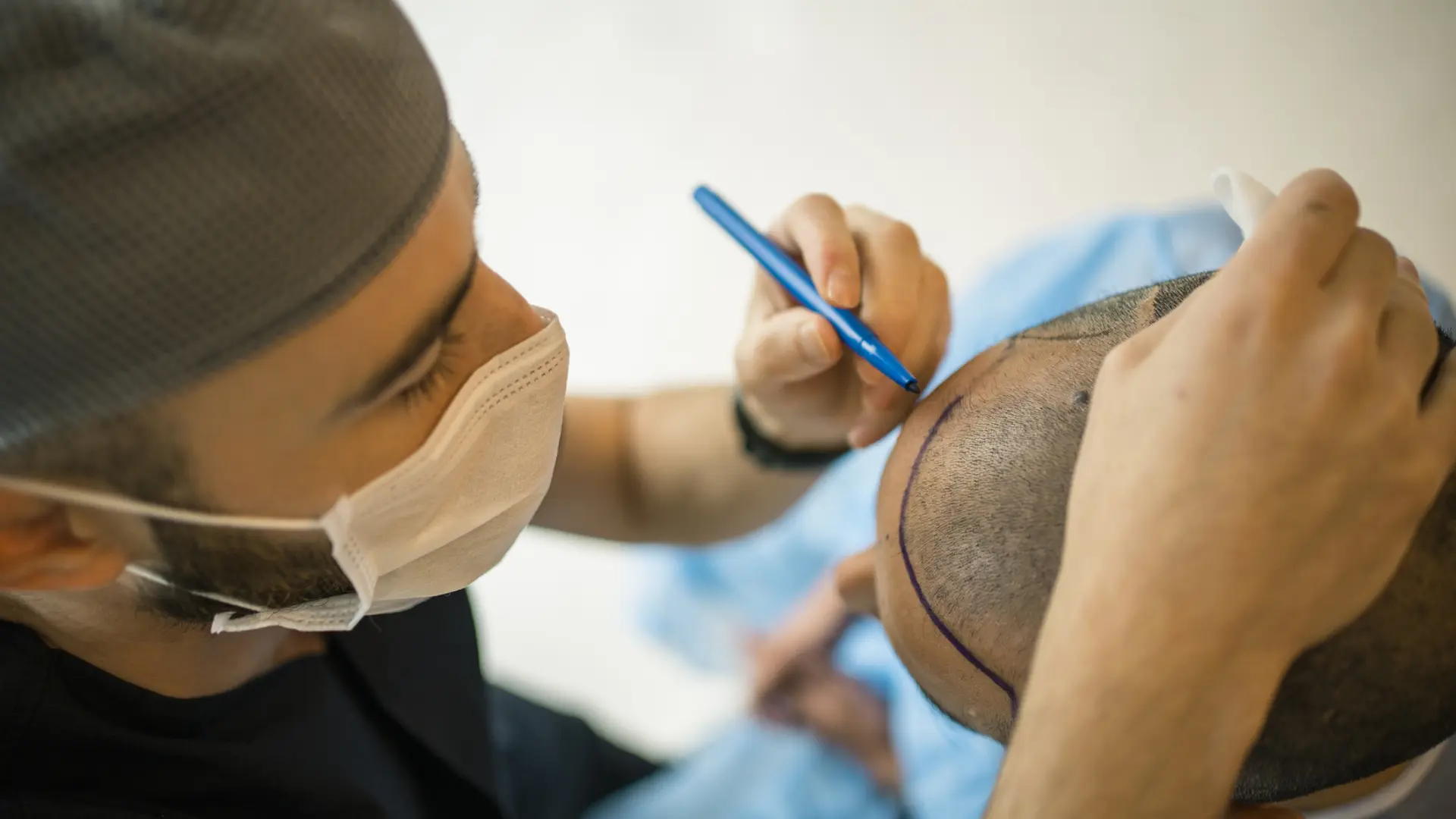 Muere un hombre tras realizarse un trasplante capilar: estos son los riesgos y efectos secundarios más comunes thumbnail
