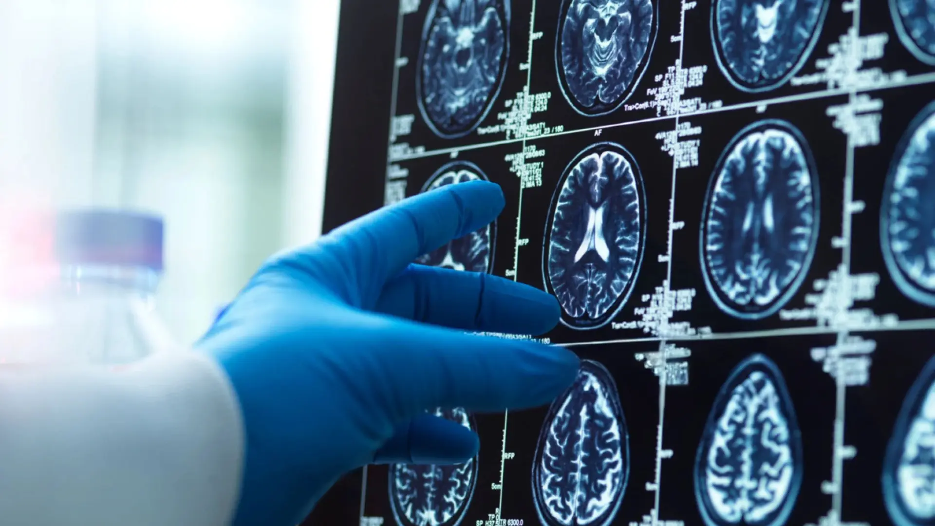 Crean nanoimplantes cerebrales que sustituyen a la cirugía para curar enfermedades como el alzhéimer