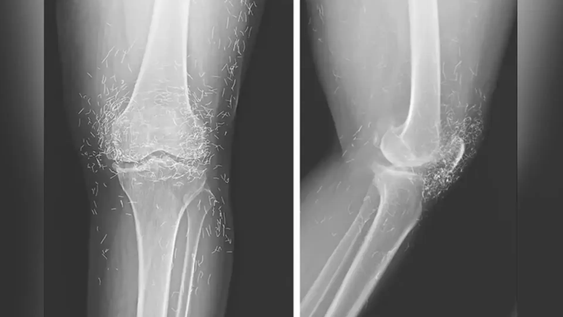 Una mujer acude al médico por problemas de rodilla y descubre que tenía hilos de oro puro incrustados
