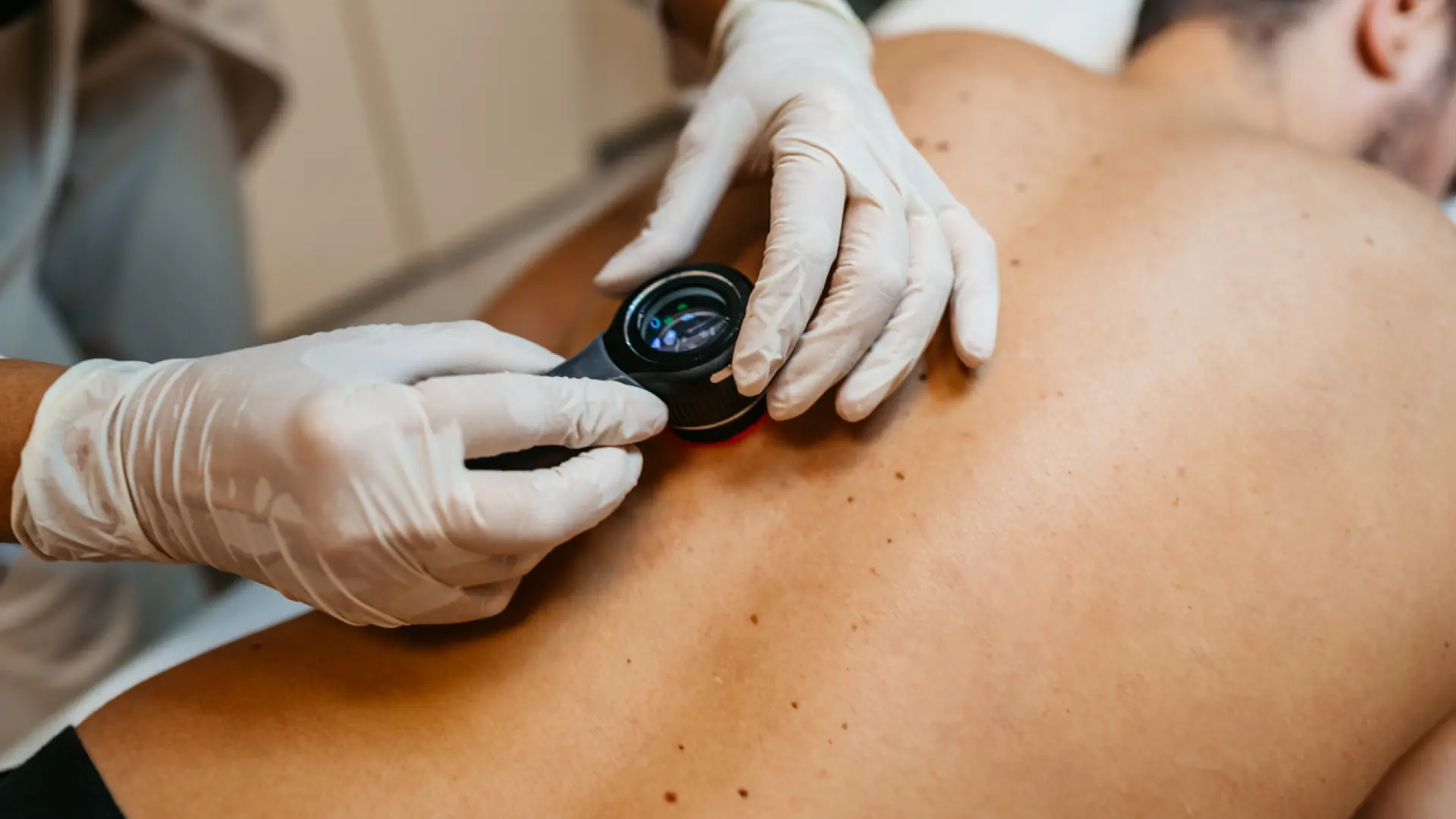 Gel radiactivo: así funciona la revolucionaria técnica contra el cáncer de piel puesta en marcha en Cataluña