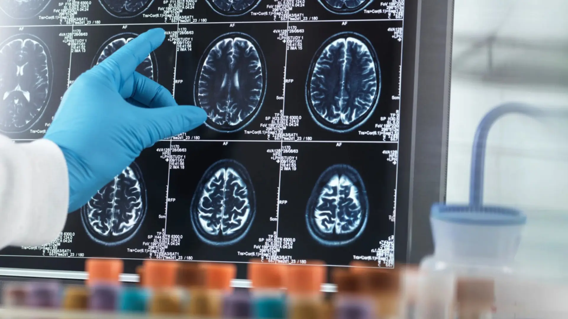 Un nuevo tratamiento con implantes cerebrales está revolucionando el tratamiento del párkinson