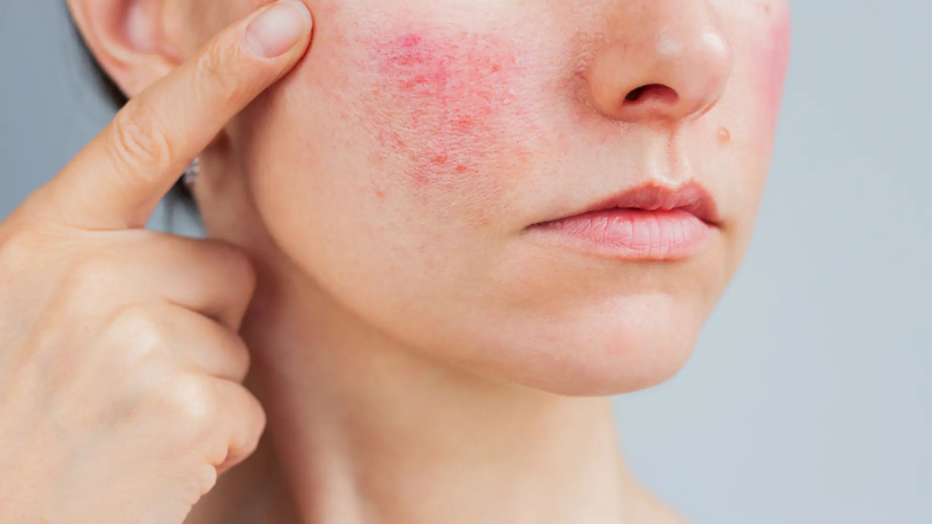 ¿Tienes rosácea? Una dermatóloga rompe con los mitos para hacer la rutina de skincare perfecta