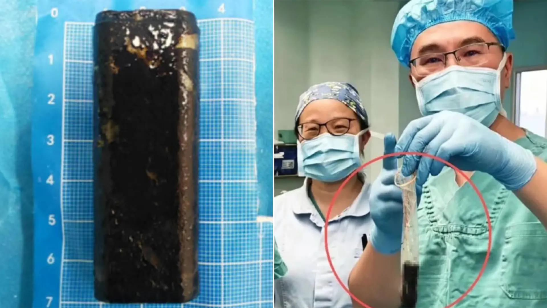 Pasa 34 años con un mechero en su estómago, los médicos se lo extraen y todavía funciona