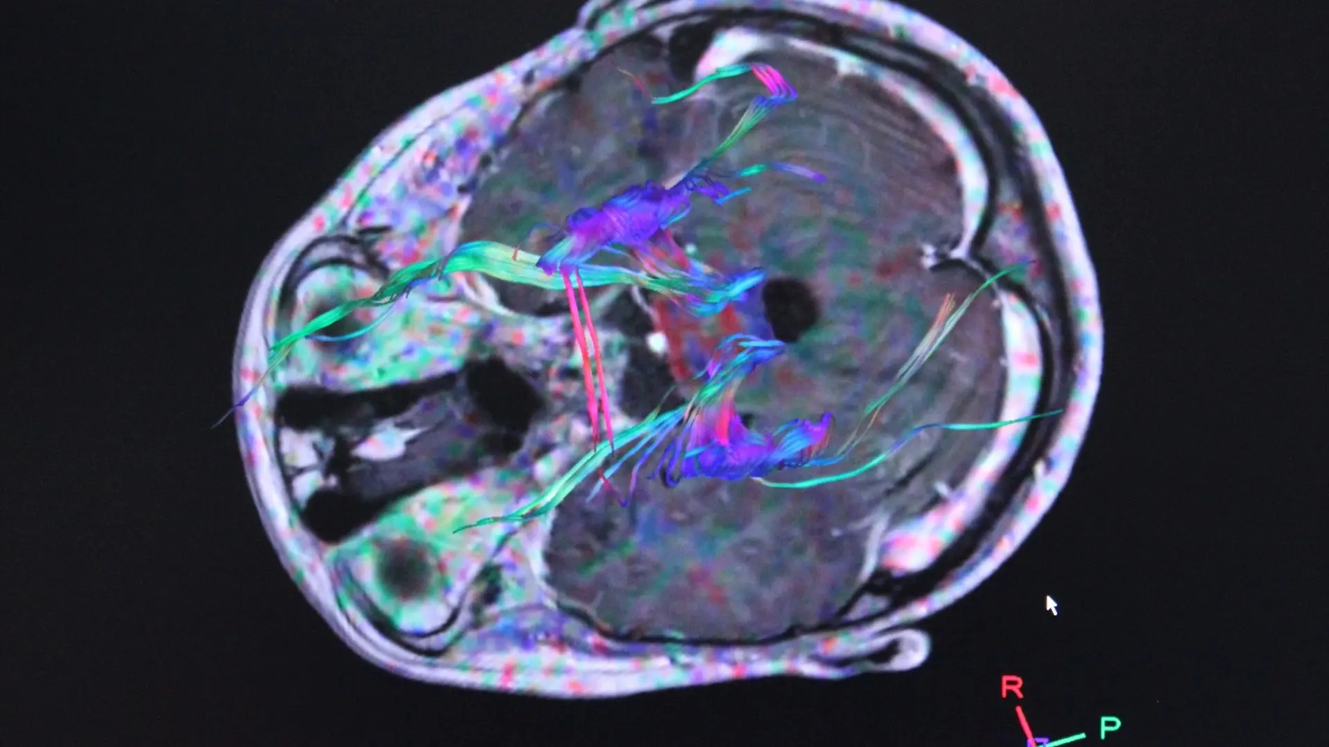 Учёные связывают болезни мозга и кишечника для диагностики Паркинсона