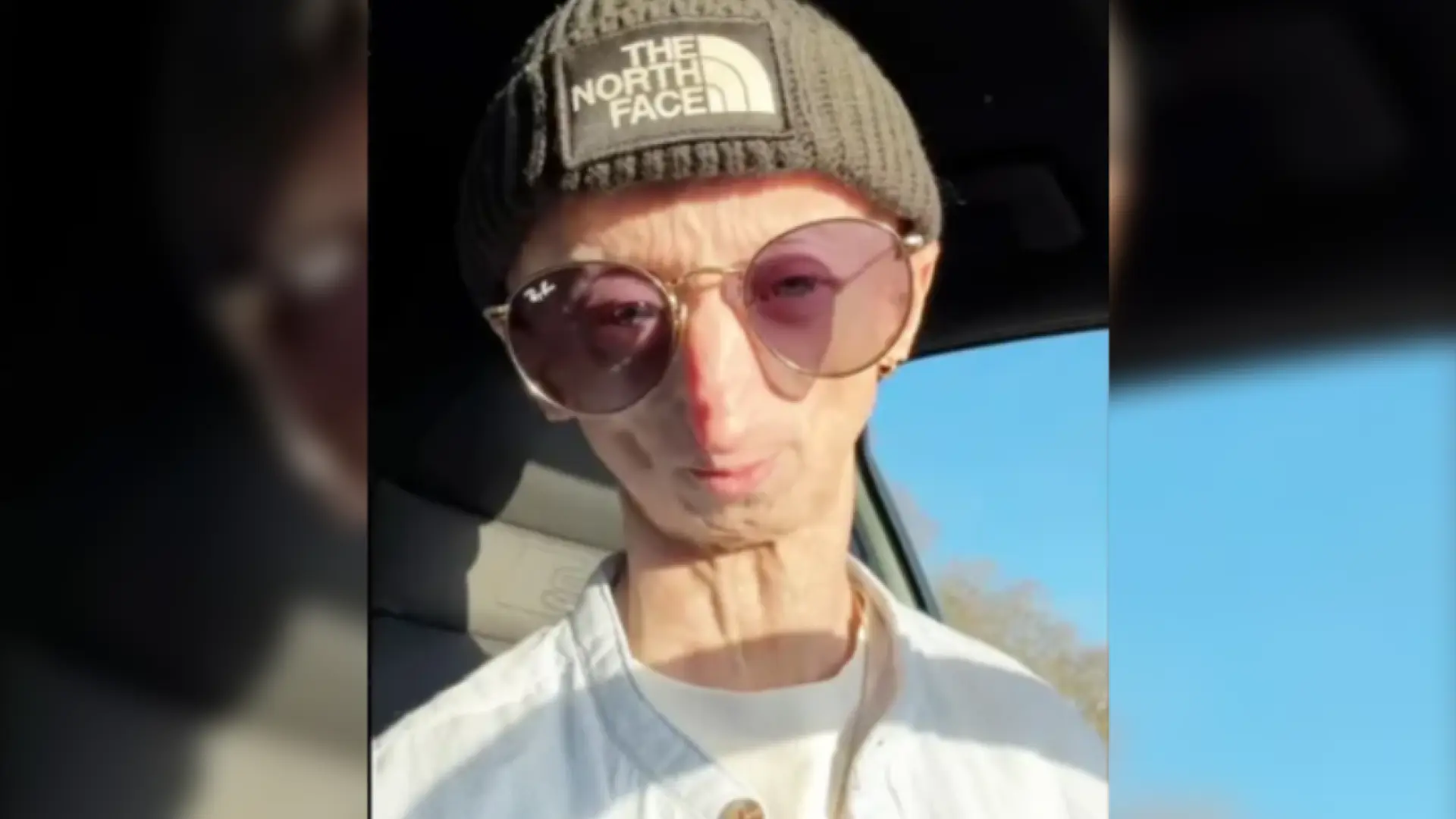 Muere a los 28 años el 'influencer' belga Michiel Vandeweert, conocido por mostrar su enfermedad genética ultrarrara