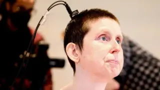 El sistema implanta unos electrodos en el cerebro del paciente.