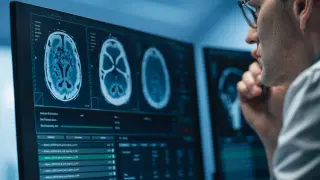 Dos de los cinco casos son meningiomas, el tipo más común de tumor cerebral benigno