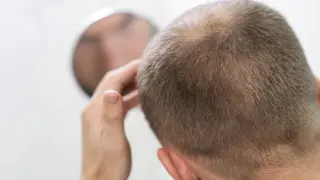 Una dieta poco variada puede ser la clave de la pérdida excesiva de pelo.