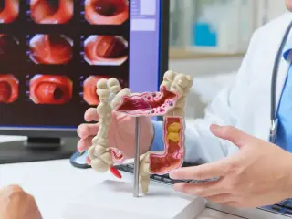 El cáncer de colon es uno de los más frecuentes en el mundo.