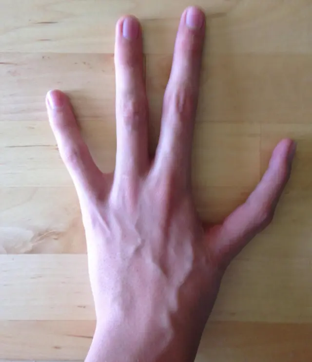 Esta mano izquierda es tan sorprendente que tiene solo cuatro dedos y un índice en lugar de pulgar, tras una intervención quirúrgica. (evan4765)