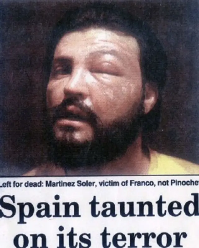 Foto de mi cara quemada, tras haber sido secuestrado y torturado por un comando de la guardia civil franquista del general Campano, por mi artículo sobre la purga de moderados en la Benemérita.