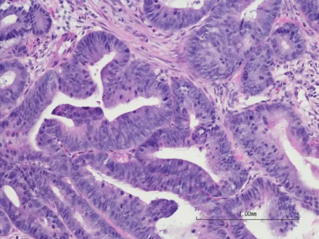 Células de cáncer de colon