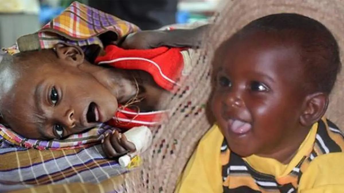 Imagenes Niños De Africa En Desnutricion La historia de Minhaj, un bebé que sobrevivió a Somalia gracias a un campo  de refugiados