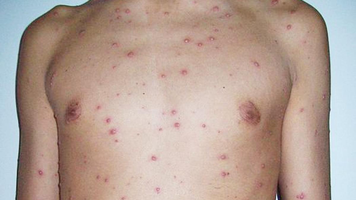 Un niño, afectado por la varicela.