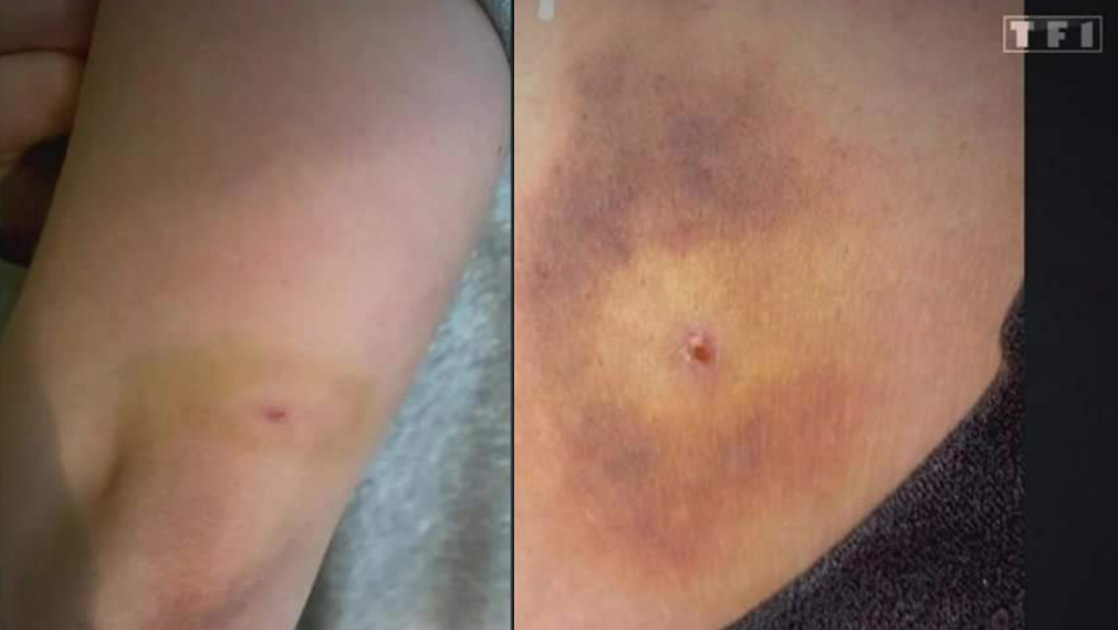 Los casos siguen aumentando. Se trata de jóvenes que dicen haber sentido un pinchazo mientras tomaban una copa por la noche o asistían a un concierto. Notar el pinchazo y luego, con mayor o menor rapidez, sentir vértigo, dolores de cabeza o nauseas.