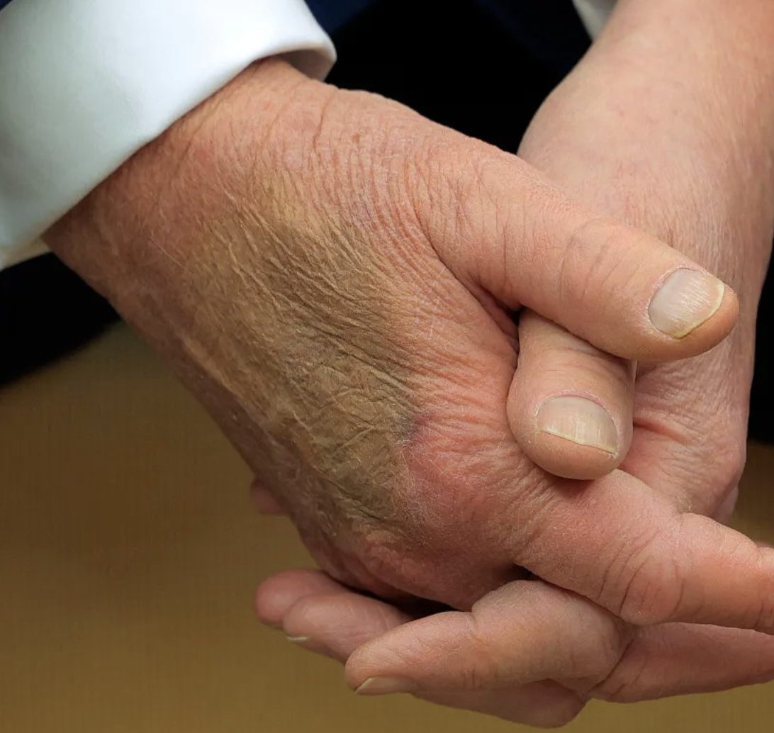 El presidente Trump tiene moretones en la mano porque está constantemente trabajando, dijo la Casa Blanca