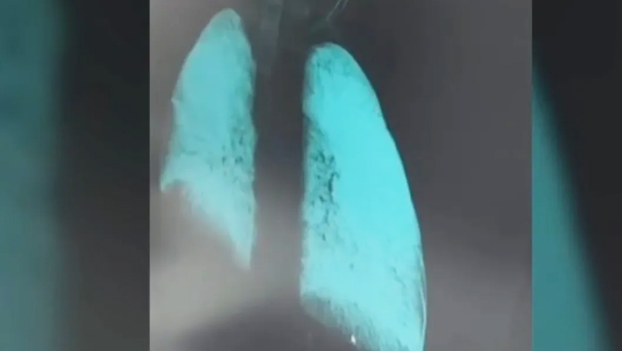 Radiografía de los pulmones de un soldado ruso afectados por neumonitis química.